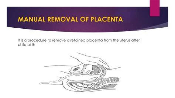 How do you get rid of retained placenta?